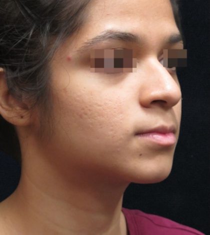 Rhinoplasty Before & After Patient #11949