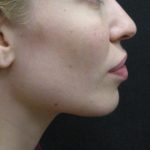 Rhinoplasty Before & After Patient #11950
