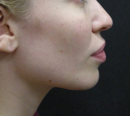 Rhinoplasty Before & After Patient #11950
