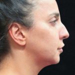 Rhinoplasty Before & After Patient #11951