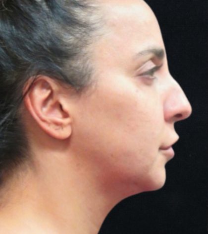 Rhinoplasty Before & After Patient #11951