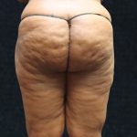 Liposuction Before & After Patient #11550