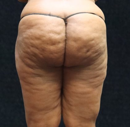 Liposuction Before & After Patient #11550