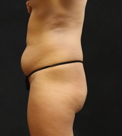 Liposuction Before & After Patient #11543