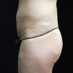 Liposuction Before & After Patient #11554