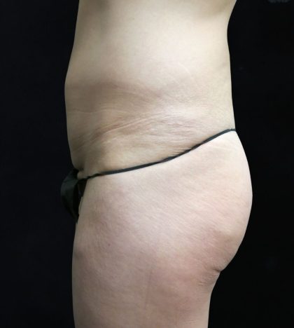 Liposuction Before & After Patient #11554
