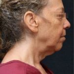 Facelift Before & After Patient #11659