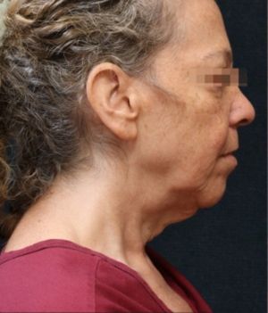Facelift Before & After Patient #11659