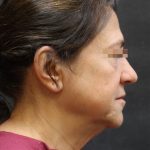 Facelift Before & After Patient #11660