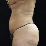 Liposuction Before & After Patient #11545