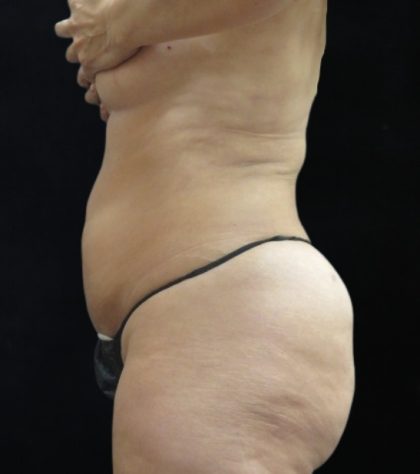 Liposuction Before & After Patient #11545