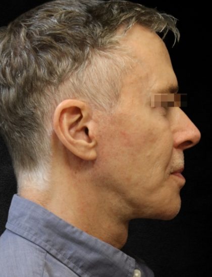 Facelift Before & After Patient #11661