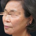 Facelift Before & After Patient #11664