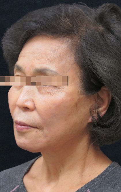 Facelift Before & After Patient #11664