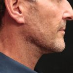 Facelift Before & After Patient #11666