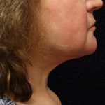 Facelift Before & After Patient #11667