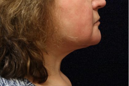 Facelift Before & After Patient #11667