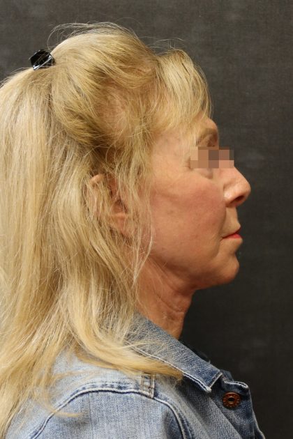 Facelift Before & After Patient #11662