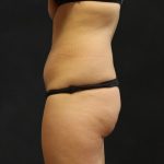 Liposuction Before & After Patient #11543