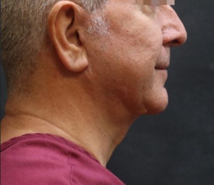 Facelift Before & After Patient #11669