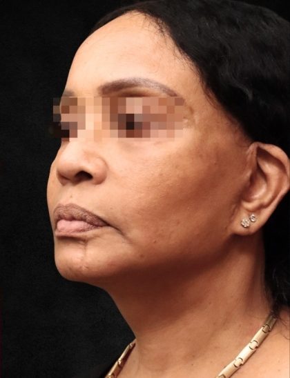 Facelift Before & After Patient #11668