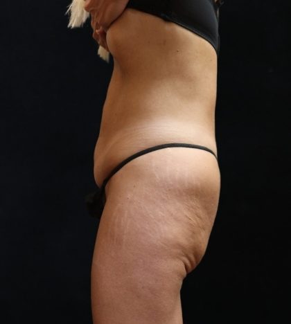 Liposuction Before & After Patient #11548