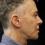 Levinelift Before & After Patient #11789