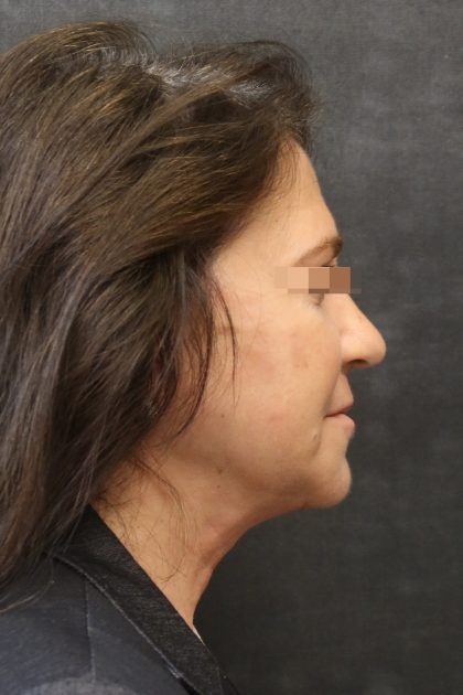 Levinelift Before & After Patient #11788