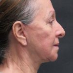 Levinelift Before & After Patient #11793