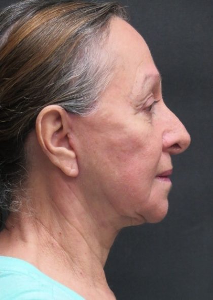 Levinelift Before & After Patient #11793