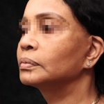 Levinelift Before & After Patient #11819