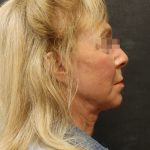 Levinelift Before & After Patient #11790
