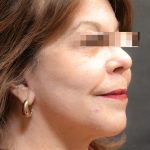 Levinelift Before & After Patient #11791