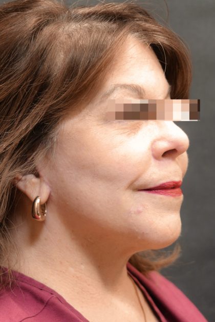 Levinelift Before & After Patient #11791