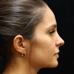 Rhinoplasty Before & After Patient #11947