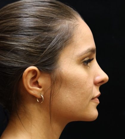 Rhinoplasty Before & After Patient #11947