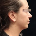Rhinoplasty Before & After Patient #11948