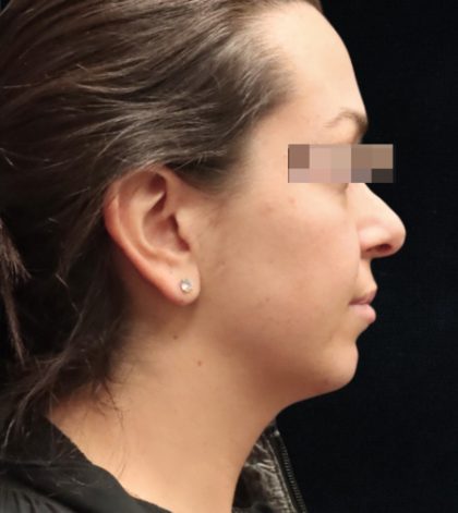 Rhinoplasty Before & After Patient #11948