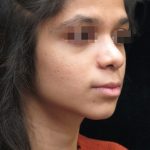 Rhinoplasty Before & After Patient #11949
