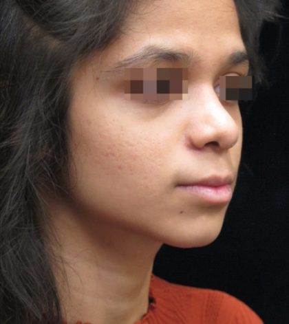 Rhinoplasty Before & After Patient #11949