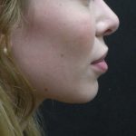 Rhinoplasty Before & After Patient #11950