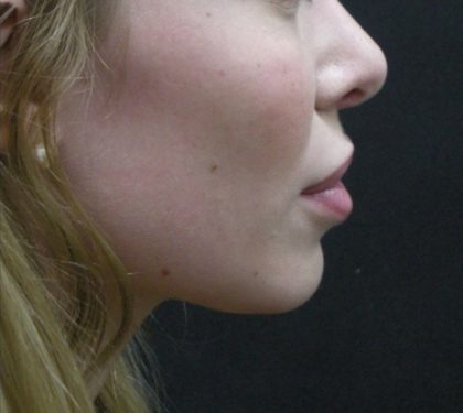Rhinoplasty Before & After Patient #11950