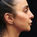 Rhinoplasty Before & After Patient #11951