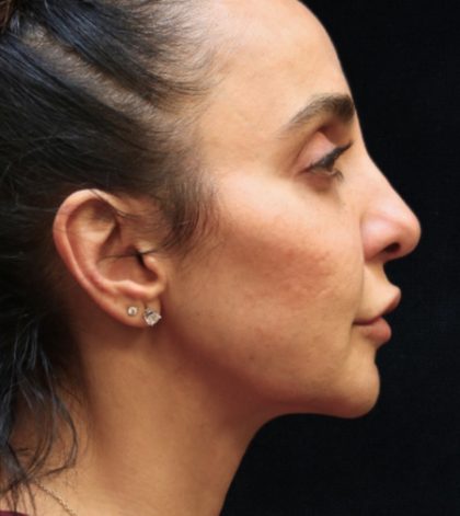 Rhinoplasty Before & After Patient #11951
