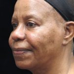 Rhinoplasty Before & After Patient #11952