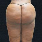 Liposuction Before & After Patient #11550