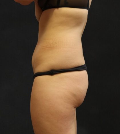 Liposuction Before & After Patient #11543
