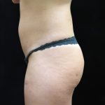 Liposuction Before & After Patient #11554