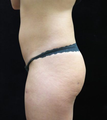 Liposuction Before & After Patient #11554