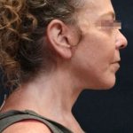 Facelift Before & After Patient #11659